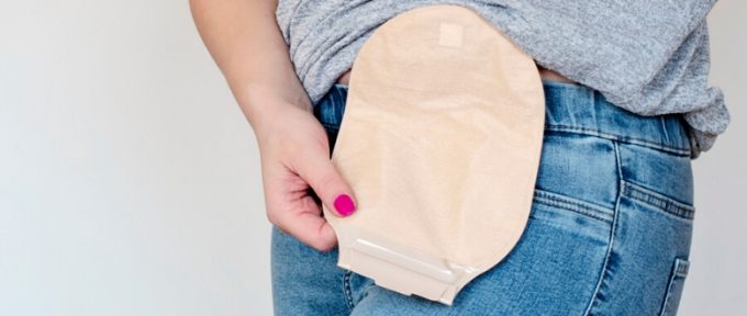 lady with a stoma